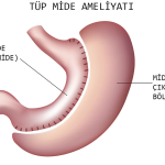 Tüp Mide Ameliyatı