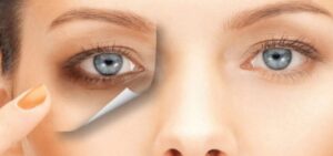 Göz Altı Morlukları Neden Olur?