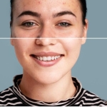 Kimlere leke mezoterapisi uygulanabilir?