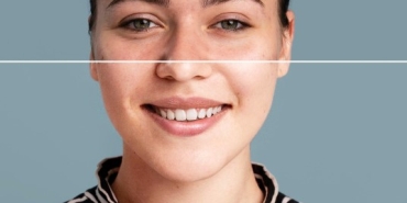 Kimlere leke mezoterapisi uygulanabilir?