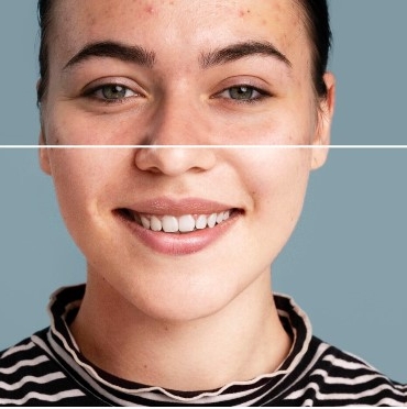 Kimlere leke mezoterapisi uygulanabilir?