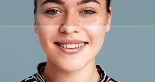 Kimlere leke mezoterapisi uygulanabilir?