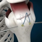 Rotator Manşet Yırtığı