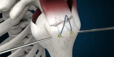 Rotator Manşet Yırtığı