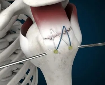 Rotator Manşet Yırtığı