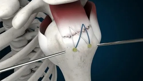 Rotator Manşet Yırtığı