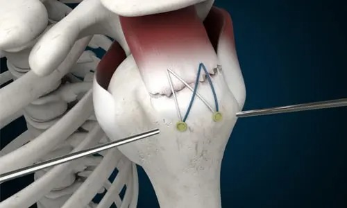 Rotator Manşet Yırtığı