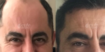 Este Surgery ile Doğal Sonuç Odaklı fue