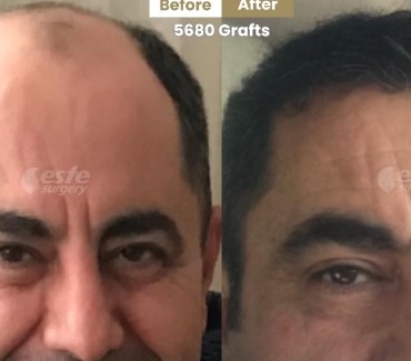 Este Surgery ile Doğal Sonuç Odaklı fue