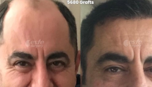 Este Surgery ile Doğal Sonuç Odaklı fue
