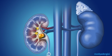 Böbrek Taşı Düşürme Sürecini Hızlandıran En Doğal Formüller