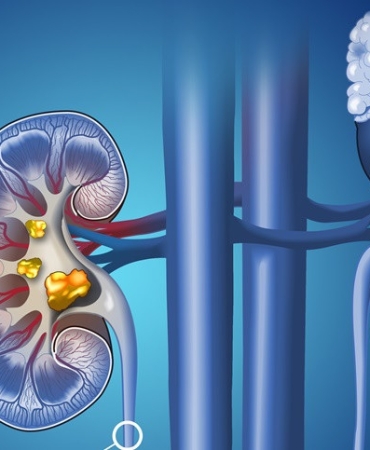 Böbrek Taşı Düşürme Sürecini Hızlandıran En Doğal Formüller
