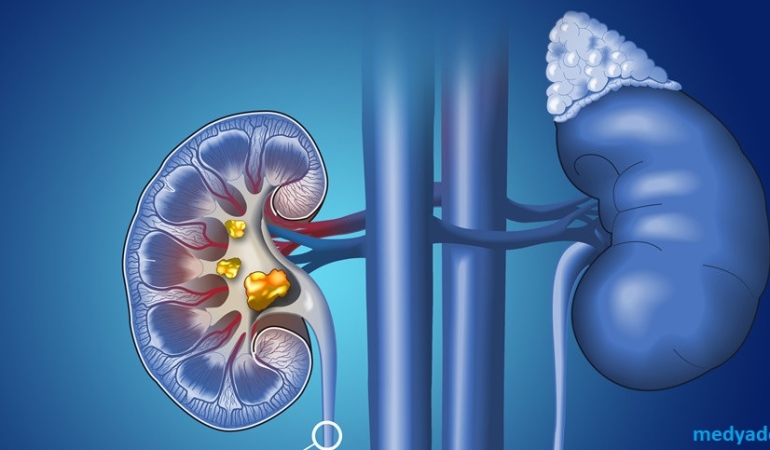 Böbrek Taşı Düşürme Sürecini Hızlandıran En Doğal Formüller